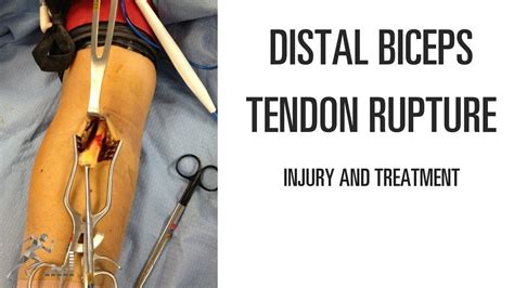 treatment of biceps tendon rupture